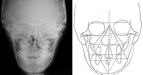 Radiografía Postero Anterior Inicial