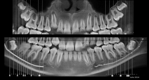 Tomografía Cone Beam Inicial