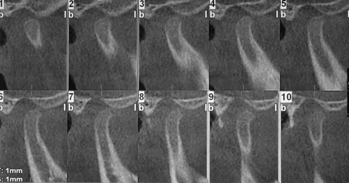 Tomografía Cone Beam Inicial