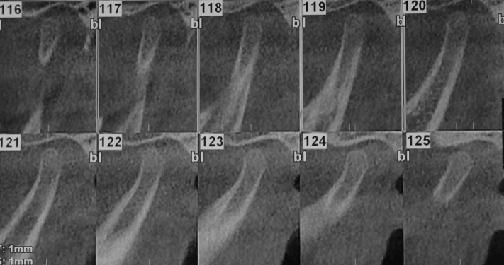 Tomografía Cone Beam Inicial