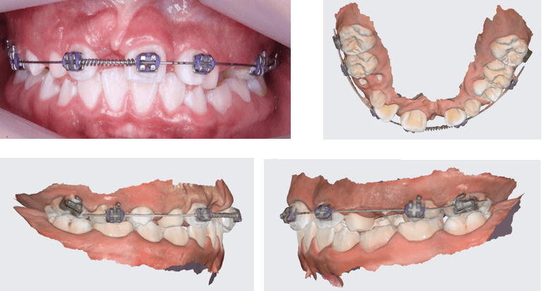 Fig 1-4. Fotografía intraoral de frente y capturas de pantalla de escaneo intraoral vista oclusal, lateral derecha e izquierda