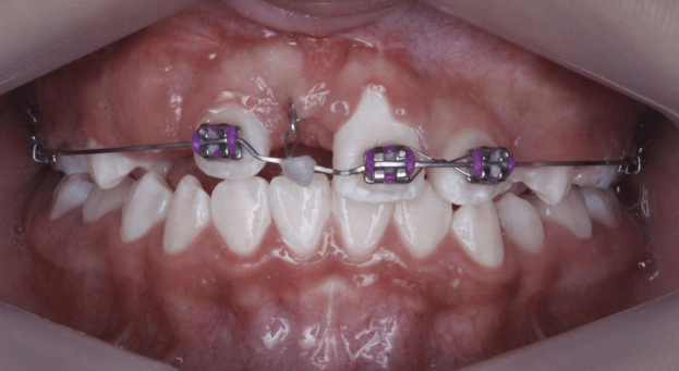 Fig 16. Fotografía de activación del botón de tracción 