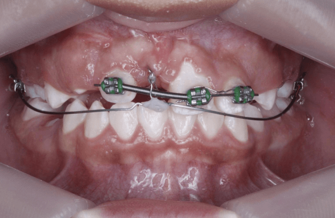 Fig 17. Fotografía de arco segmentado 0.018 para tracción de incisivo central 1.1