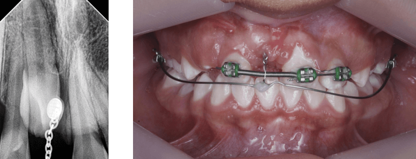 Fig 18. Rx periapical N2 - Fig 20. Fotografía control de arco segmentado