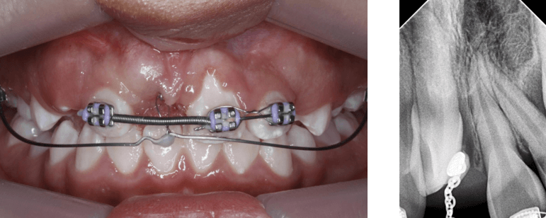 Fig 21. Fotografía de abultamiento de encía vestibular - Fig 22. Rx periapical N3