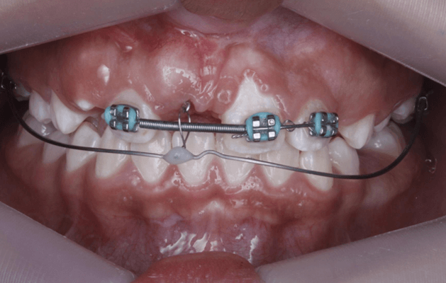 Fig 23. Fotografía de rompimiento de encía vestibular, arco de 17 x 25 TMA