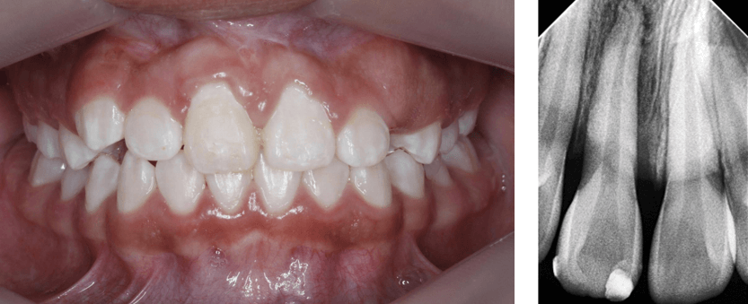 Fig 27. Fotografía post retiro de aparatología fija - Fig 28. Rx periapical N4