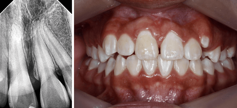 Fig 29. Rx periapical N5 - Fig 30. Fotografía de control 6 meses después de retiro
