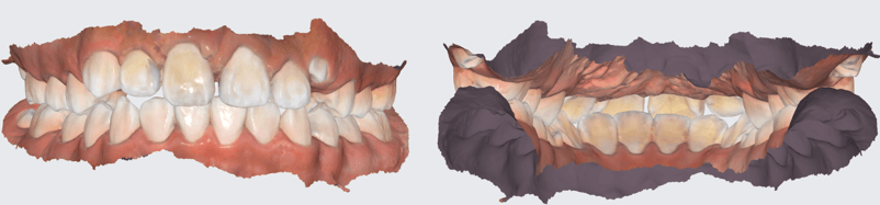 Fig 31 y 32. Imágenes de escaneo digital intraoral, control 6 meses.