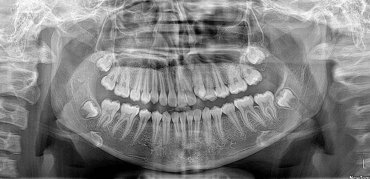 Fig 33. Radiografía panorámica de control 1 año y 4 meses después