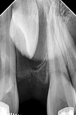 Fig 11. Rx periapical con técnica de bisectriz