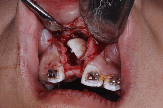 Fig 12. Ventana Quirúrgica y frenectomía labial