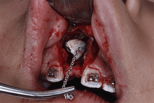 Fig 13. Fotografía colocación de botón cóncavo con cadeneta para tracción