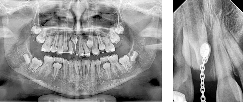 Fig 14 y 15. Rx periapical N1 con botón y cadeneta y Rx panorámica