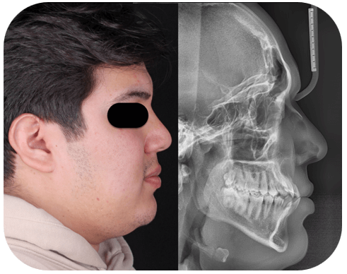 Fig 4. Radiografia lateral de craneo inicial