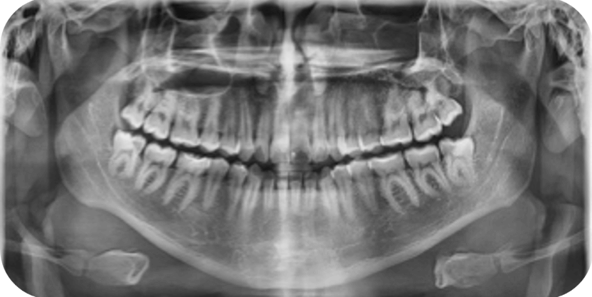 Fig 4.2 Radiografia panoramica inicial