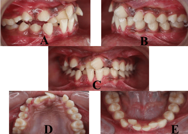 Figure 2:Intraoral examnation,A.Right lateral,B.Left lateral,C.Frontal,D.Maxillary arch,E.Mandibular arch