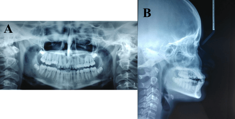 Figure 3:Radiographic examination,A.OPG,B.Lateral cephalogram