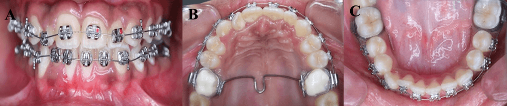 Figure 5:A,B.Intraoral photographs after correction of rotation,C.Mandibular arch