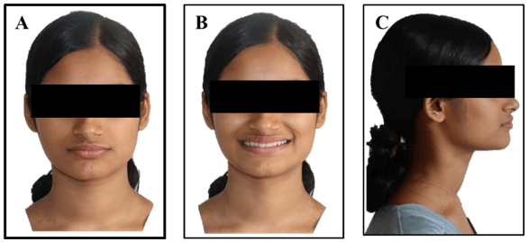 Figure 6: Post treatment extraoral photographs,A.Frontal,B.Smile,C.Profile