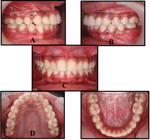 Figure 7: Post treatment intraoral photographs,A.Right lateral,B.Left lateral,C.Frontal,D.Maxillary arch,E.Mandibular arch