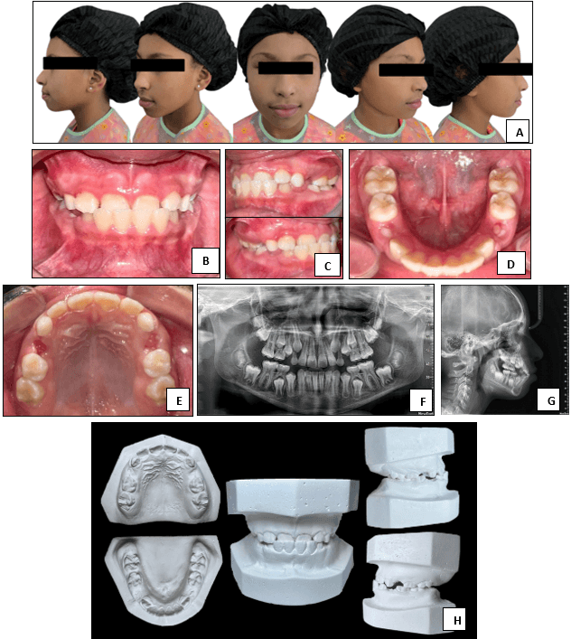 Figura 1. Fotografías clínicas pretratamiento. (A) Fotografías extraorales, (B) Fotografía intraoral en MIC, (C) Fotografía intraoral en MIC lateral derecha e izquierda, (D) Fotografía intraoral oclusal maxilar, (E) Fotografía intraoral oclusal mandibular, (F) Radiografía panorámica, (G) Radiografía lateral de cráneo pretratamiento, (H) Modelos de estudio.