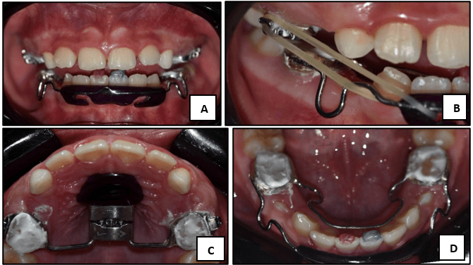 Figura 2. Cementación de apartología. (A) Fotografía intraoral en oclusón, (B) Fotografía intraoral lateral derecha, (C) Fotografía intraoral superior, (D) Fotografía intraoral inferior. 