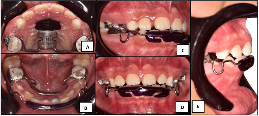 Figura 3. Fotografías intraorales - control a las 2 semanas; (A) vista de arcada superior, (B) vista de arcada inferior, (C) vista lateral derecha, (D) vista frontal en oclusión. (E) vista lateral derecha extraoral.