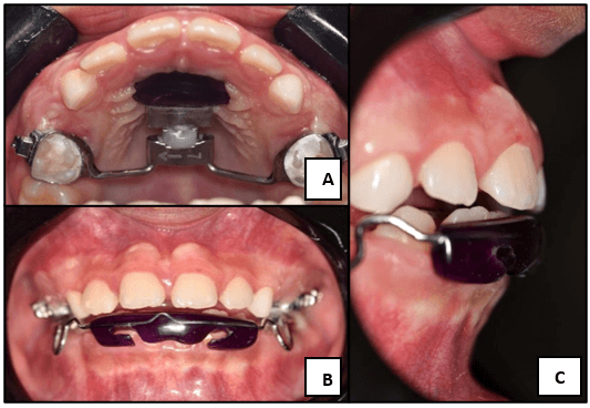 Figura 4. Fotografías intraorales - Control a las 3 semanas; (A) vista de arcada superior, (B) vista en oclusión. (C) vista lateral derecha extraoral.