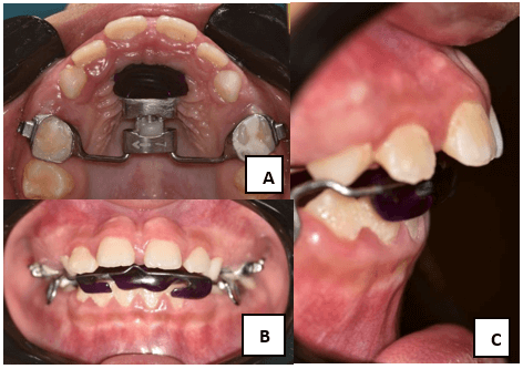 Figura 5. Fotografías intraorales - Control a las 5 semanas; (A) vista de arcada superior, (B) vista en oclusión. (C) vista lateral derecha extraoral.