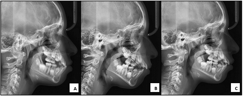 Figura 8. Radiografía lateral de cráneo; (A) inicial, (B) control inmediato (mordida abierta transitoria), (C) postratamiento.
