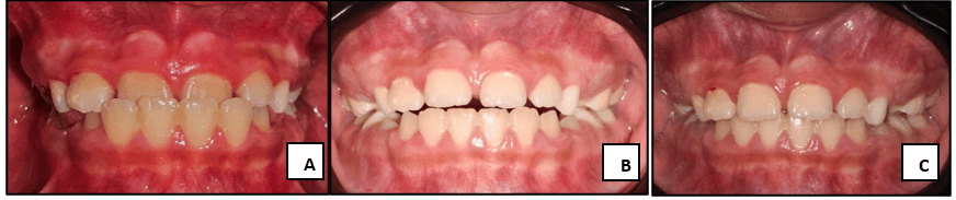 Figura 9. Fotografías clínicas de evolución. (A) Fotografía intraoral inicial, (B) Fotografía intraoral control inmediato (mordida abierta transitoria), (C) Fotografía intraoral postratamiento.