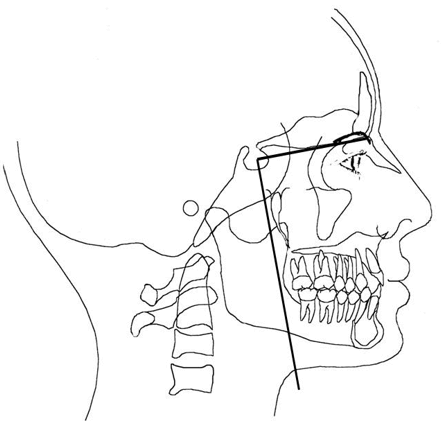 Podremos medir el crecimiento o desplazamiento del maxilar trazando perpendiculares a la línea base desde la espina nasal anterior (ANS), del punto sub-espinal (punto A), si deseamos evaluar el desplazamiento anterior de la mandíbula podremos medir hasta punto supra mental (punto B) y  pogonion (Pg)
