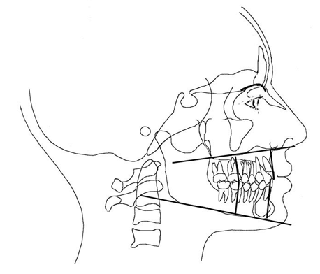 Esto nos permite evaluar el grado de intrusión o extrusión de los dientes y molares, en las correcciones de mordidas abierta o en mordidas profundas, nivelación de curva de Spee o en procedimientos quirúrgicos. Los movimientos horizontales de los incisivos se miden tanto en el borde incisal, como en el ápice con relación a la distancia de estos al plano N-P. Esto nos permite visualizar cuantos milímetros se han inclinado las raíces o las coronas de los incisivos, protruyéndose o retruyéndose.
