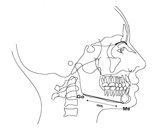 En sentido vertical, el movimiento de los incisivos superiores e inferiores se mide desde el borde incisal en perpendicular hasta el plano palatino o mandibular, respectivamente, al igual que los molares en su cúspide mesial de los primeros molares