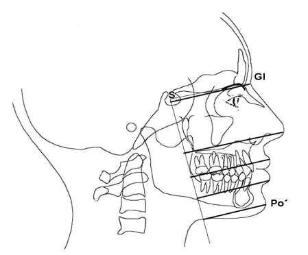 De igual manera pueden realizarse otras mediciones como variaciones en inclinación del plano oclusal, relacionándolo con la base anterior el cráneo, (silla-Nasion) trazando una perpendicular desde el plano oclusal hasta los puntos Nasion y Silla