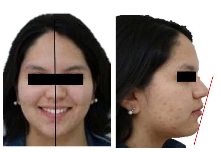Fig.6 Extraoral de sonrisa final / Fig. 7 Perfil