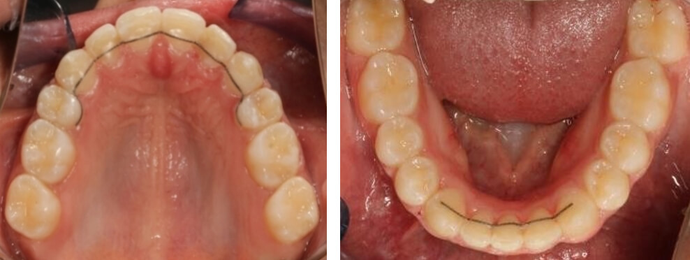 Fig. 8 Oclusales finales superior e inferior