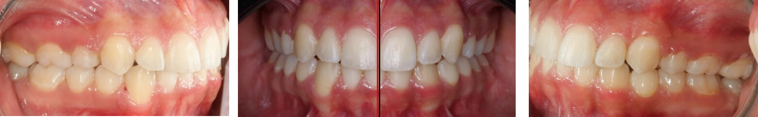 Fig. 9 Intraorales finales de frente, lateral derecha e izquierda