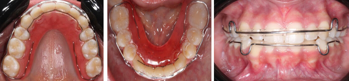Fig. 11 Retenedores circunferenciales superior e inferior vista oclusal y de frente