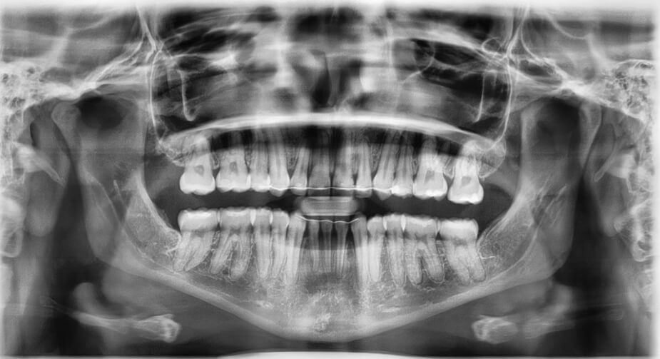 Fig. 10 Radiografía panorámica final