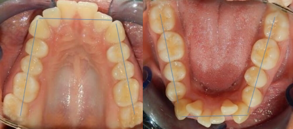 Fig. 6 vista oclusal superior e inferior