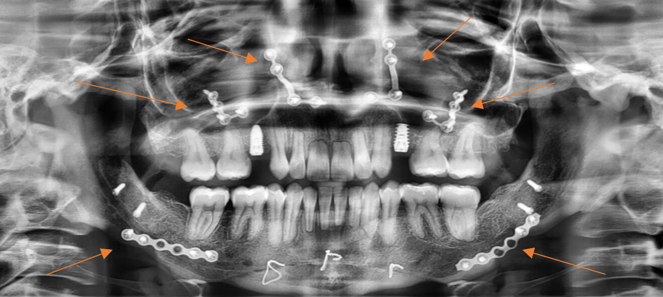 Fig. 8 radiografía panorámica