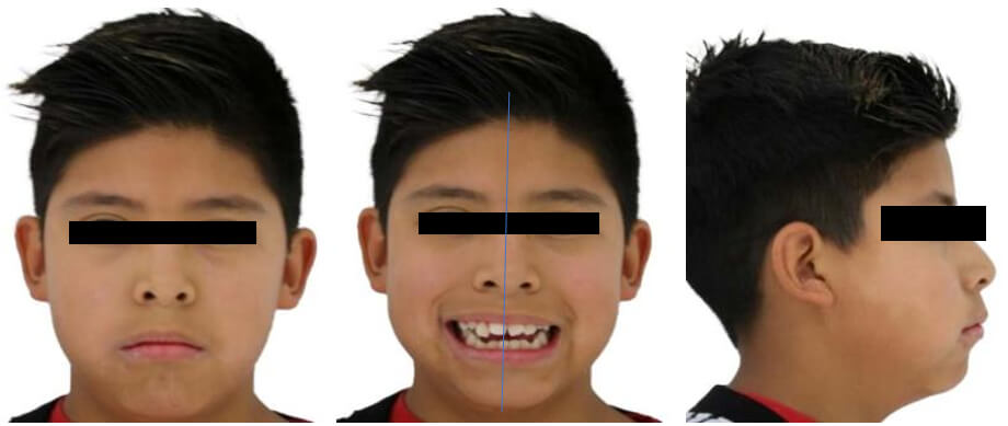 Fig.1 Frente reposo - Fig. 2 inicio - Fig. 3 Perfil