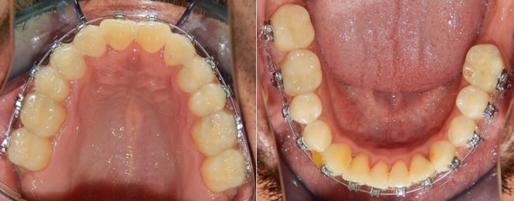 Fig. 3 vista oclusal superior e inferior