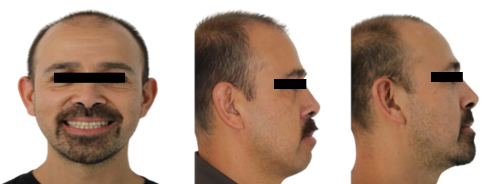 Fig. 7 frente sonrisa, perfil inicio y final