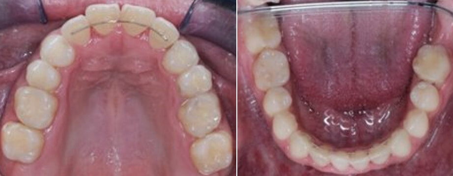 Fig. 8 oclusales superior e inferior finales