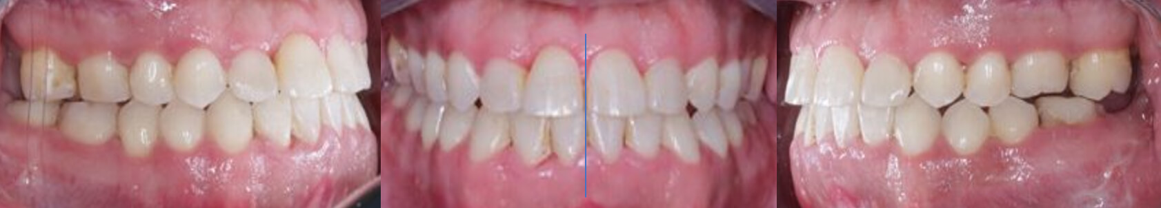 Fig. 9. Laterales derecha frente izquierda final