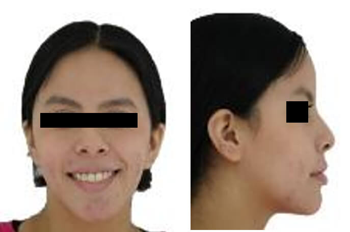 Fig.9 frente sonrisa, perfil final