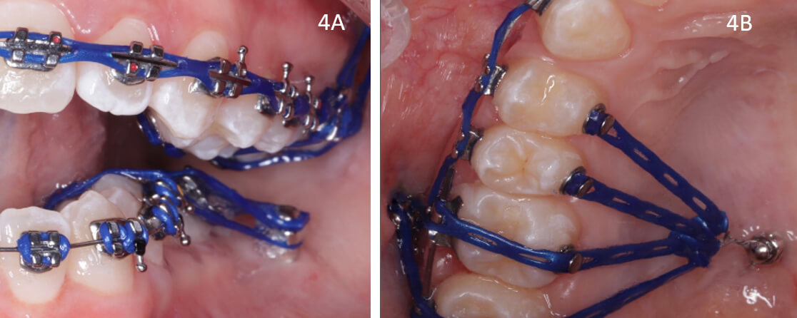 Fig. 4A microtornillo en shelf para vestibularización e intrusión de piezas posteroinferiores unilateral izquierdo. 4B microtornillo en paladar y en cresta infracigomática para intrusión de piezas posterosuperiores unilateral izquierdo